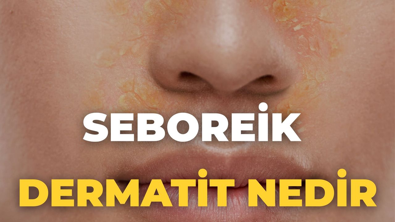 Seboreik Dermatit Nedir