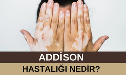 Addison Hastalığı Nedir? Belirtileri Ve Tanı Süreci