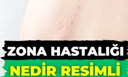 Zona Hastalığı Nedir Resimli