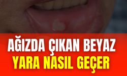 Ağızda Çıkan Beyaz Yara Nasıl Geçer