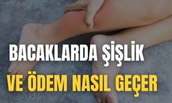 Bacaklarda Şişlik Ve Ödem Nasıl Geçer