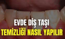 Evde Diş Taşı Temizliği Nasıl Yapılır