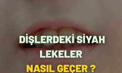 Dişlerdeki Siyah Lekeler Nasıl Geçer ?
