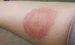 Lyme Hastalığı Nedir Belirtileri, Lyme Hastalığı Ölümcülmüdür? Lyme Hastalığı Tedavisi Varmı?