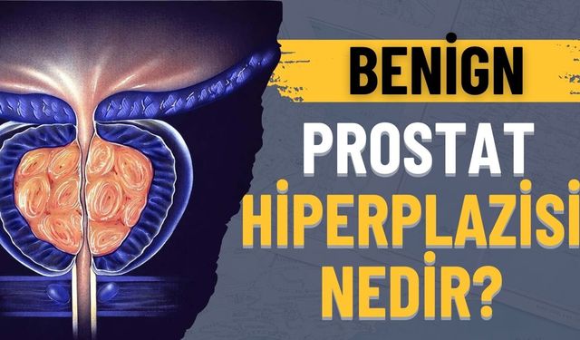 Benign Prostat Hiperplazisi Nedir?