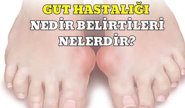 Gut Hastalığı Nedir Belirtileri Nelerdir?