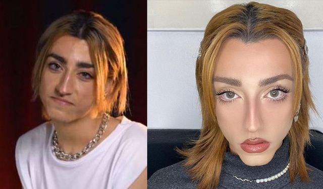 “Ağzıma Büyük Geliyor” Dedi, Dil Estetiğine Karar Verdi! Mika Can Raun Yine Gündemde