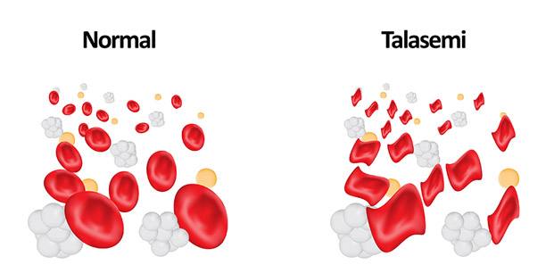 Talasemi-1