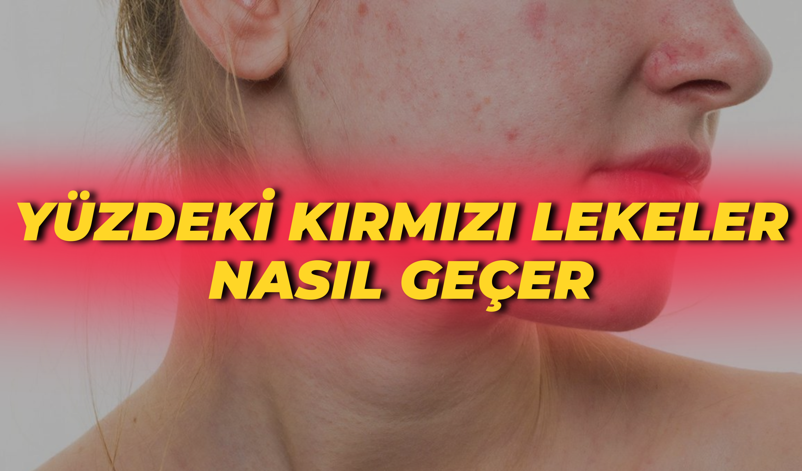 Yüzdeki Kırmızı Lekeler Nasıl Geçer