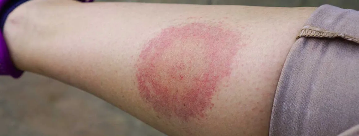 Lyme Hastalığı Nedir